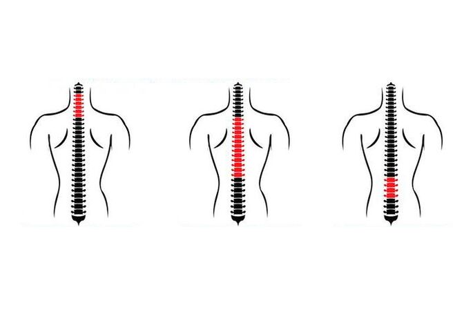 Πώς εκδηλώνεται η οστεοχονδρωσία;