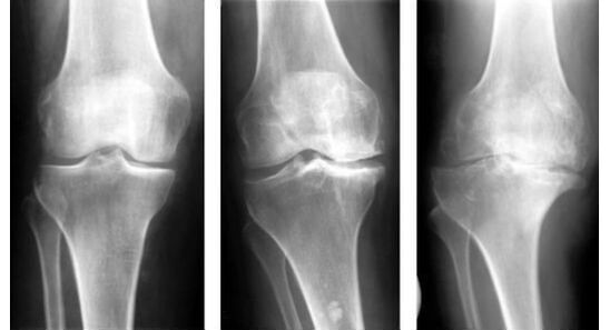 Ένα υποχρεωτικό διαγνωστικό μέτρο για τον προσδιορισμό της αρθροπάθειας του γόνατος είναι η ακτινογραφία
