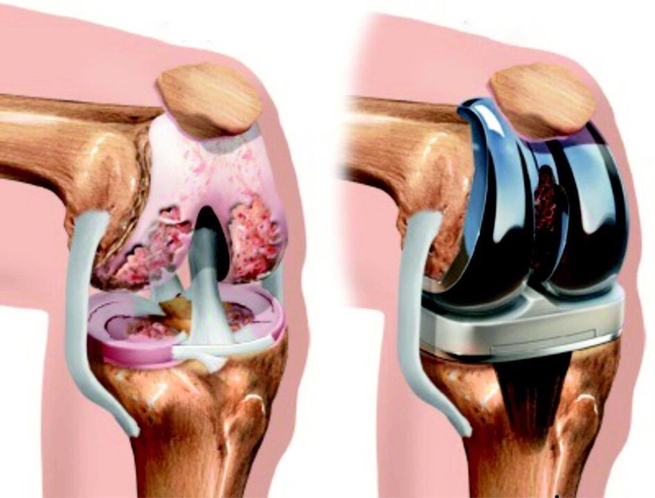 Εάν η άρθρωση του γόνατος έχει υποστεί πλήρη βλάβη από οστεοαρθρίτιδα, μπορεί να αποκατασταθεί χρησιμοποιώντας ενδοπροσθετική